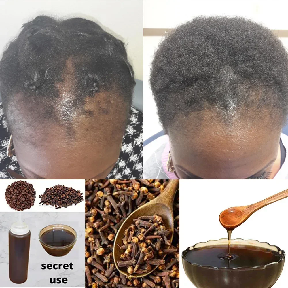 Afrika kadınlar çekiş alopesi  - Hair Care Ginseng incelemesi ve fiyatı
