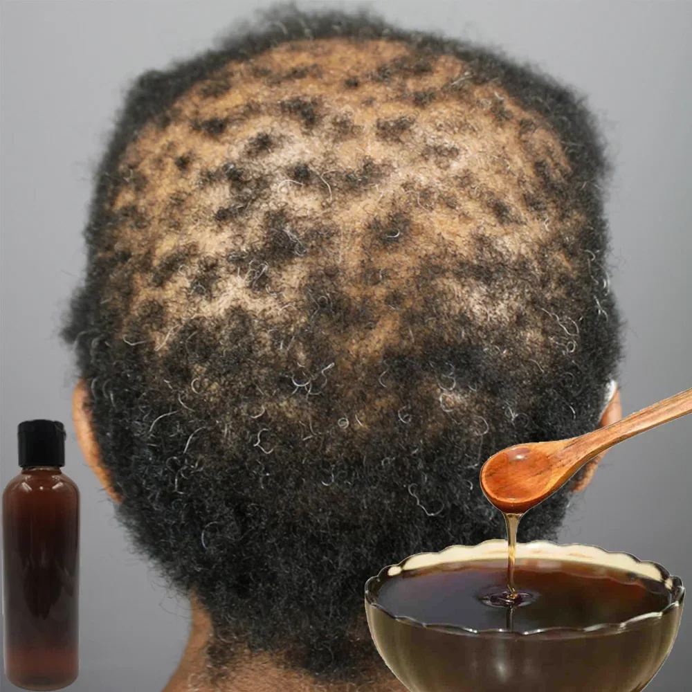 Afrika kadınlar çekiş alopesi  - Hair Care Ginseng incelemesi ve fiyatı